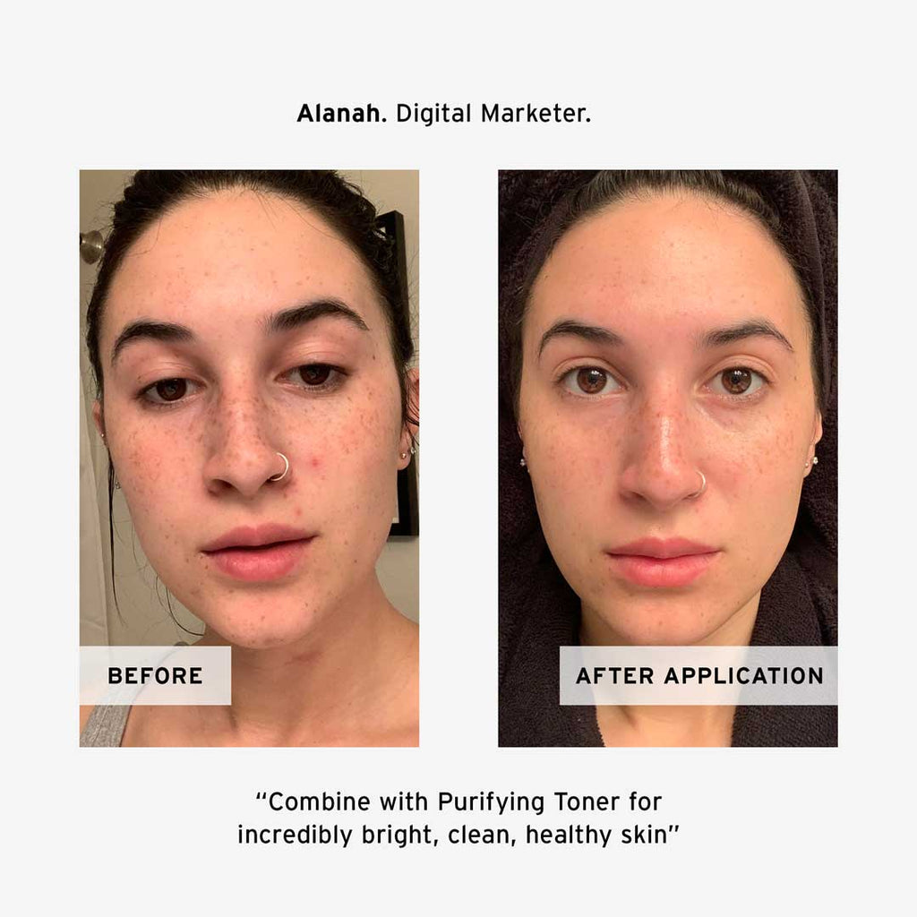 SkinResolve™ Invisible Acne Patches